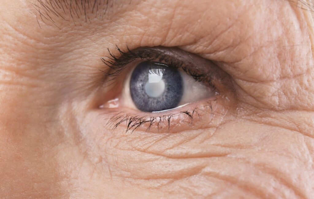 A close up of an eye with glaucoma.
