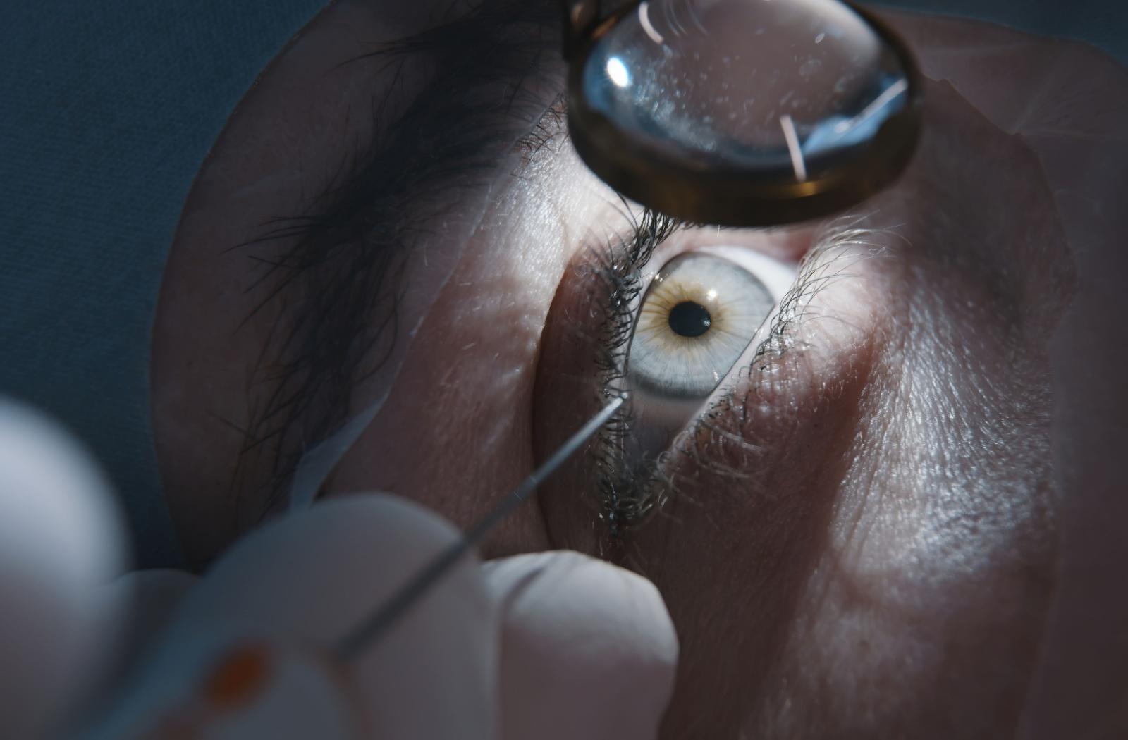 A close up of an eye being prepared for laser eye surgery.